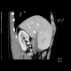 Focal nodular hyperplasia, FNH, flow rate of contrast: CT - Computed tomography